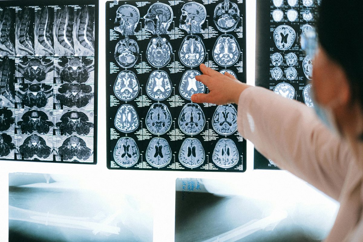 Brain Tumors