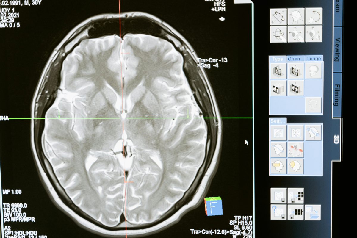 Pituitary Adenoma