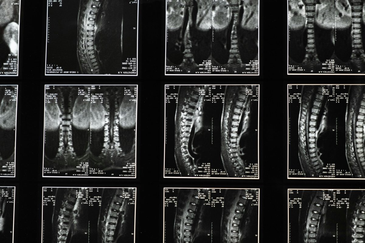 Spinal Fusion