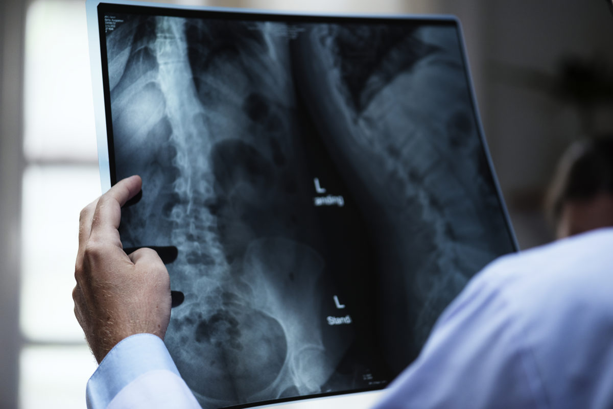 Spinal Tumors