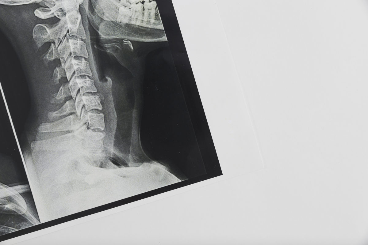 Vertebroplasty & Kyphoplasty